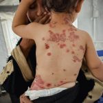 Gaza pred zdravstvenom katastrofom: 70% porodica bez sapuna i sredstava za higijenu